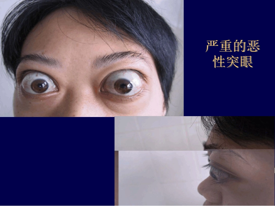 Graves眼病诊治新进展最新_第12页