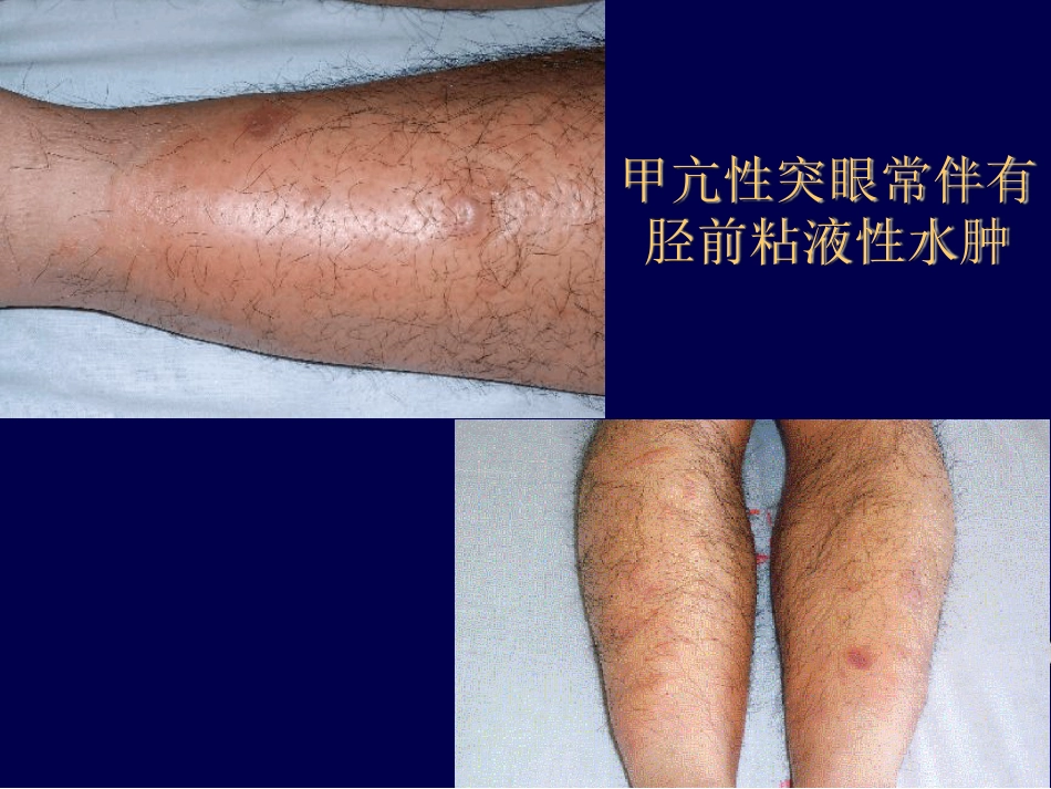 Graves眼病诊治新进展最新_第13页