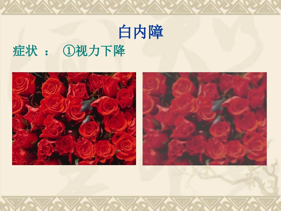 白内障的临床表现、诊断与治疗_第11页