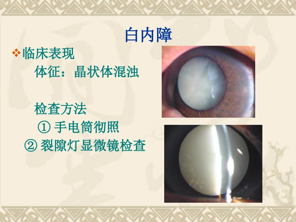 白内障的临床表现、诊断与治疗_第15页