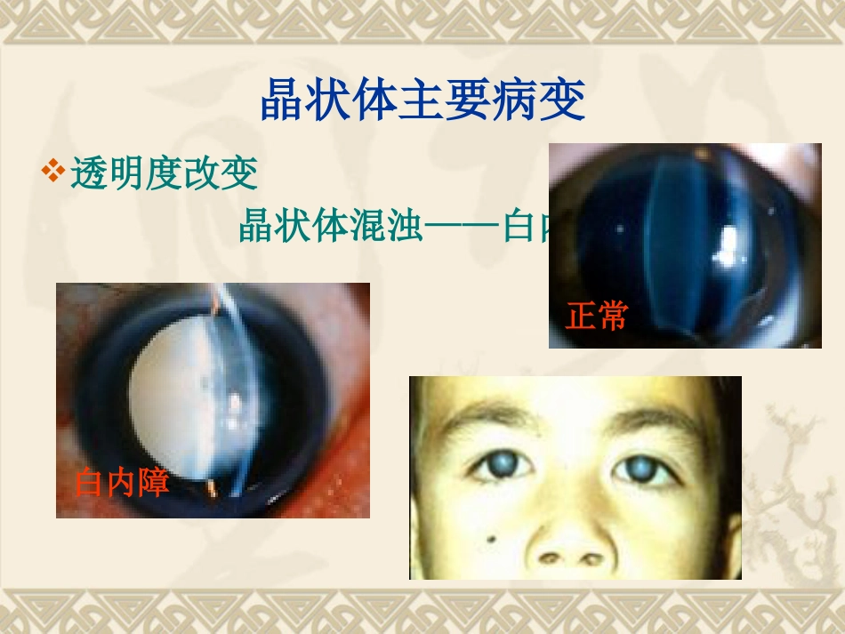 白内障的临床表现、诊断与治疗_第5页