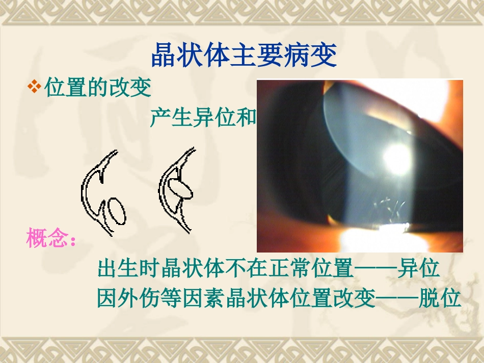 白内障的临床表现、诊断与治疗_第6页