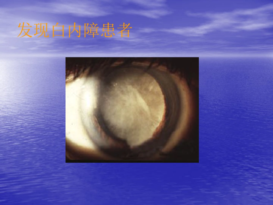白内障筛查方法_第13页