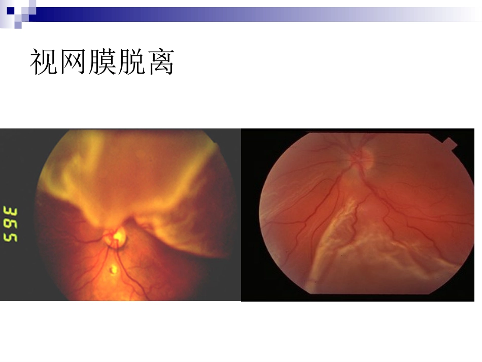 玻璃体液化及玻璃体积血_第11页