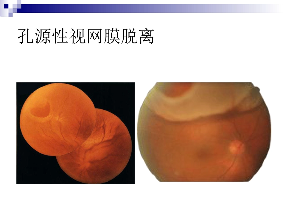 玻璃体液化及玻璃体积血_第12页