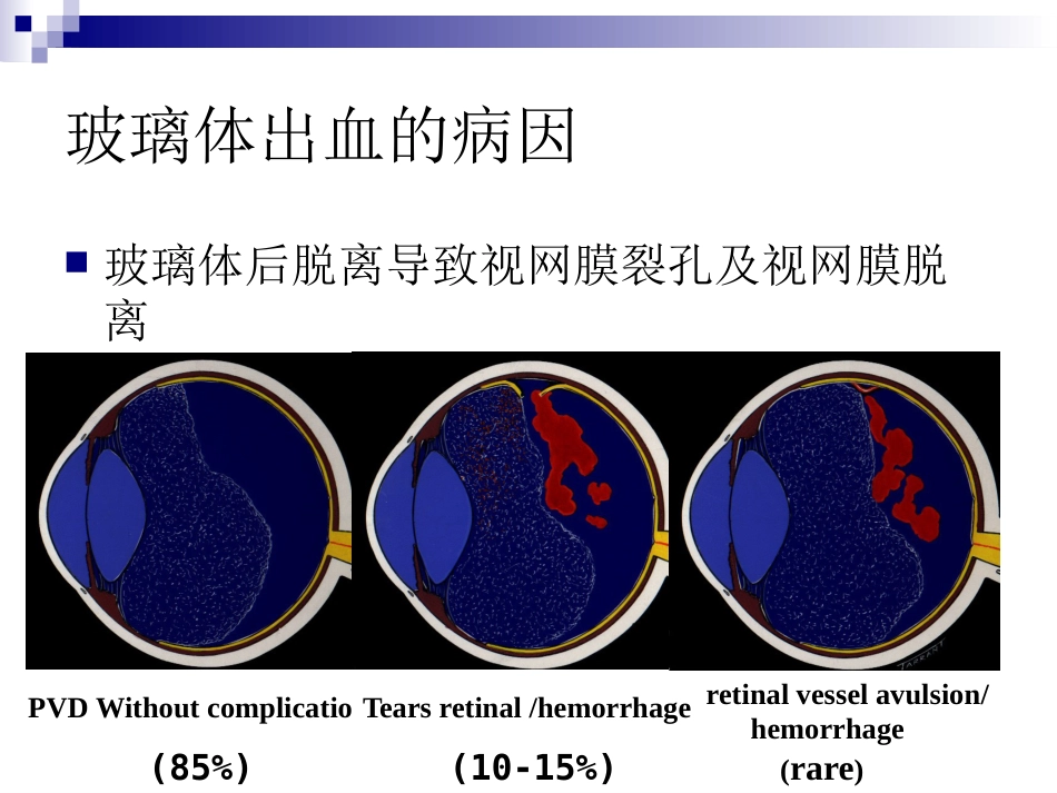玻璃体液化及玻璃体积血_第14页