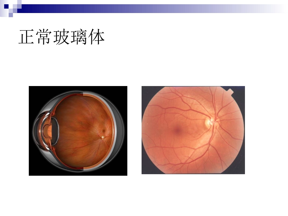 玻璃体液化及玻璃体积血_第3页