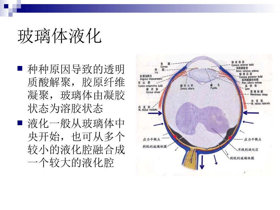 玻璃体液化及玻璃体积血_第4页