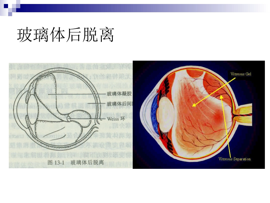 玻璃体液化及玻璃体积血_第6页