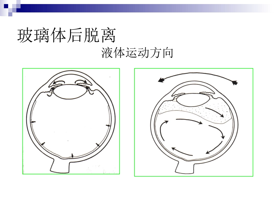 玻璃体液化及玻璃体积血_第7页