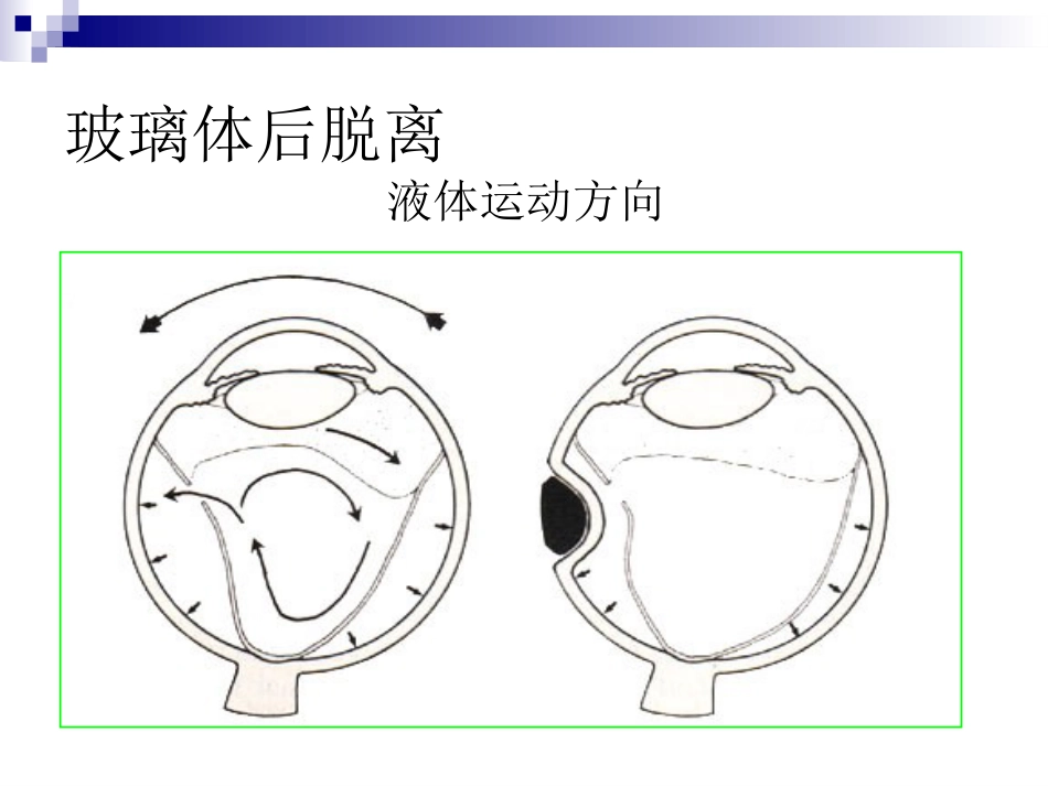 玻璃体液化及玻璃体积血_第8页