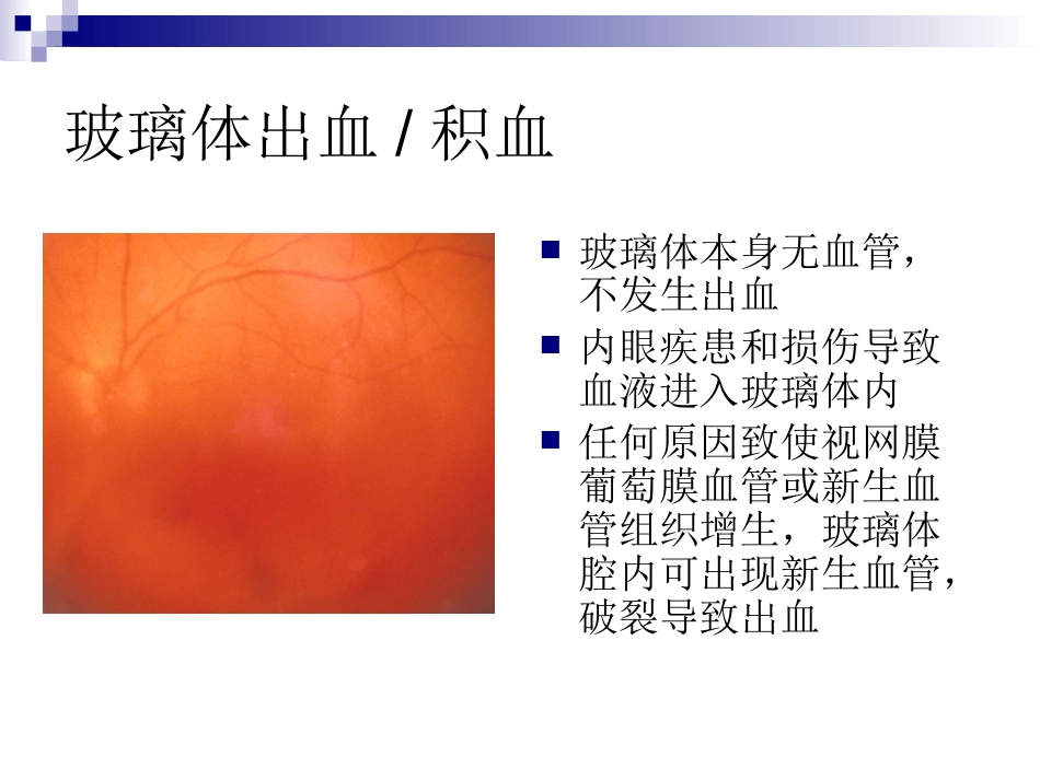 玻璃体液化及玻璃体积血_第9页