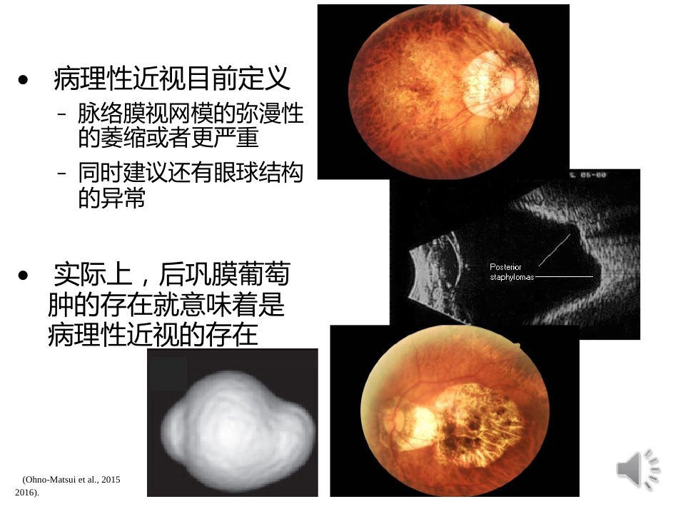 病理性近视CNV的诊断与治疗进展_第10页
