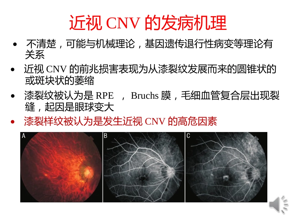 病理性近视CNV的诊断与治疗进展_第13页