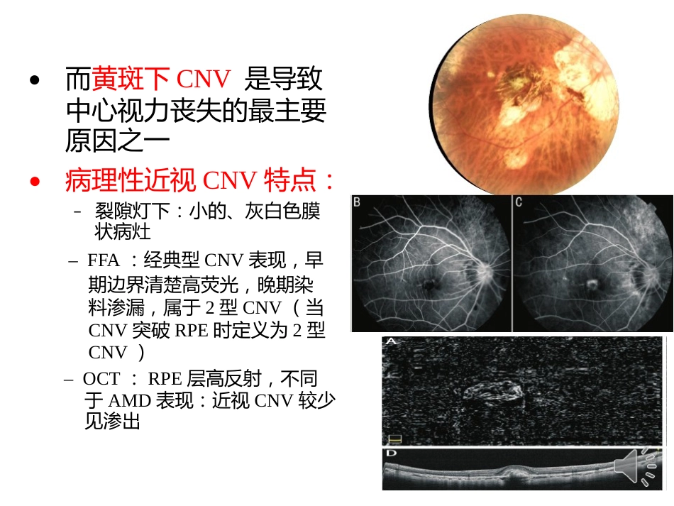 病理性近视CNV的诊断与治疗进展_第4页