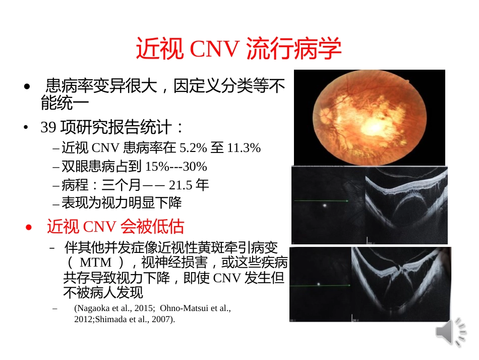 病理性近视CNV的诊断与治疗进展_第6页