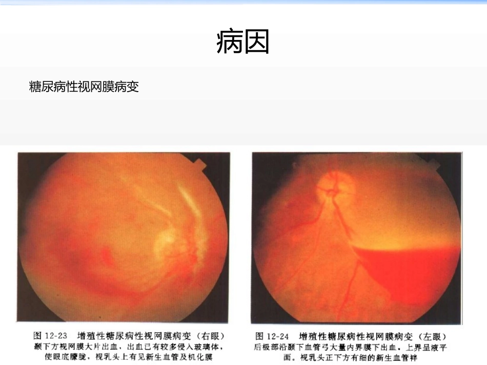 《新生血管性青光眼》_第6页