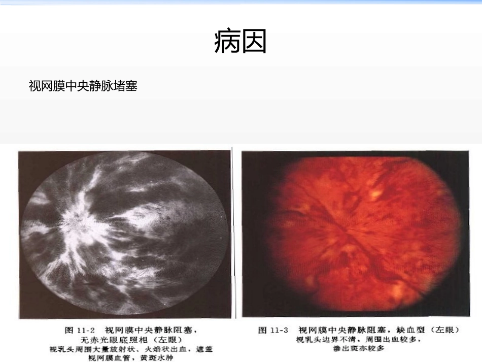 《新生血管性青光眼》_第7页