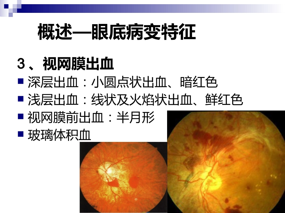 《视网膜病》_第11页