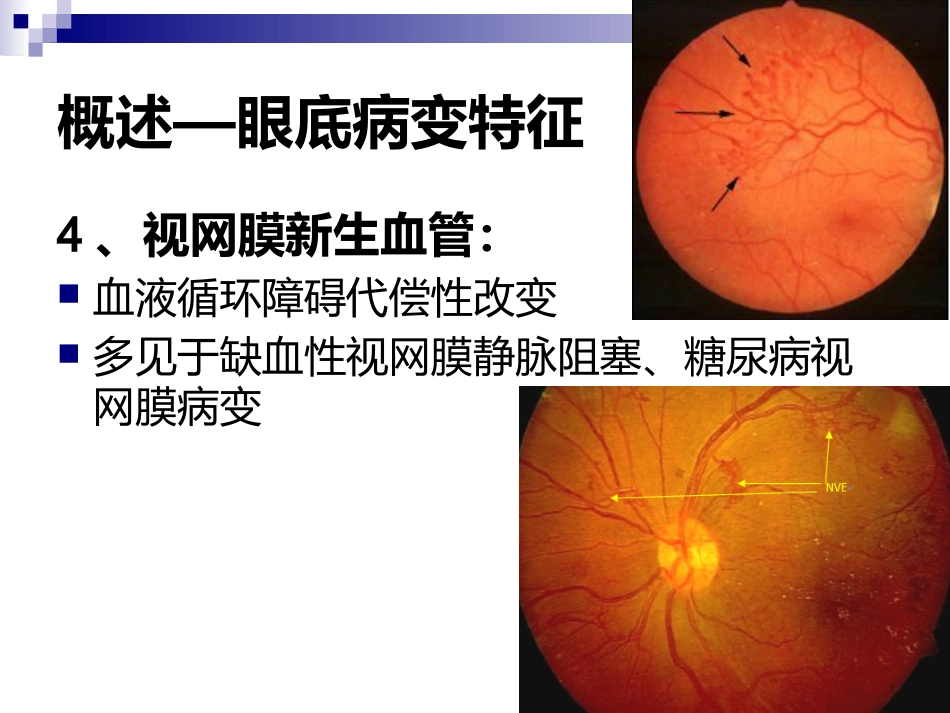 《视网膜病》_第12页