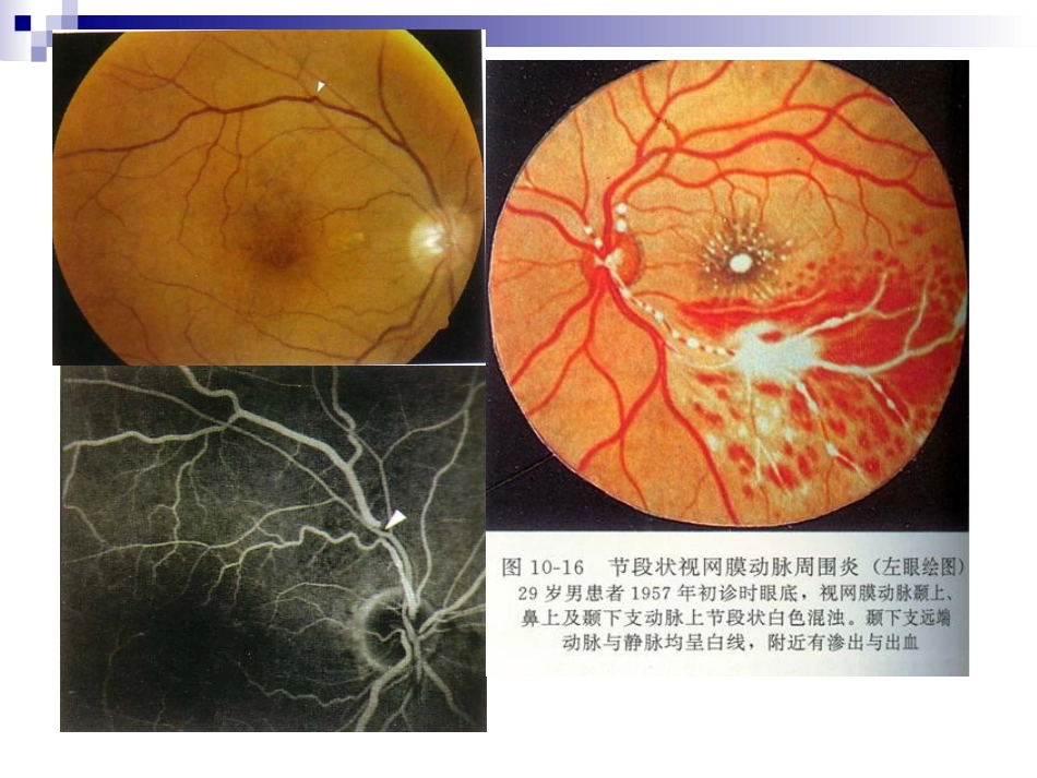 《视网膜病》_第14页