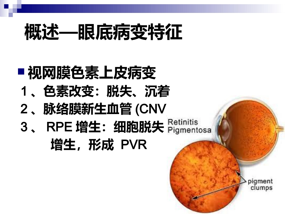 《视网膜病》_第15页