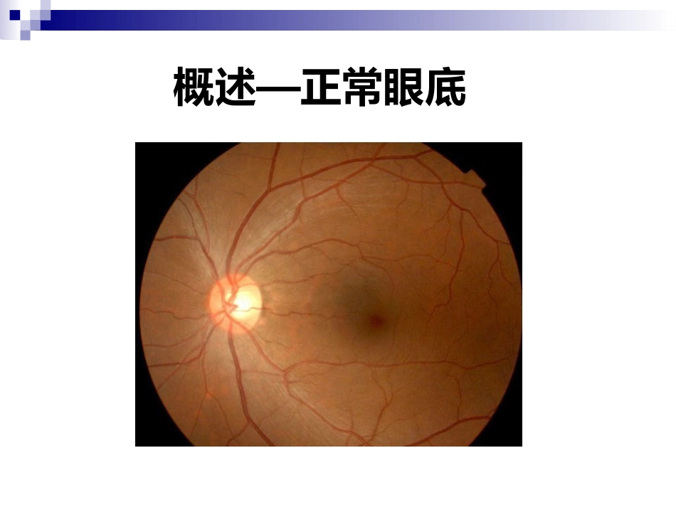《视网膜病》_第5页