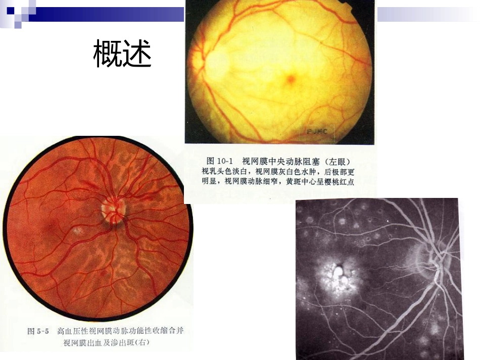 《视网膜病》_第8页