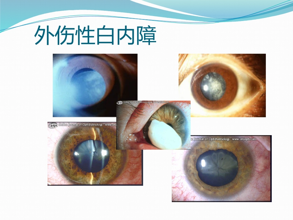 白内障的诊断与治疗_第15页
