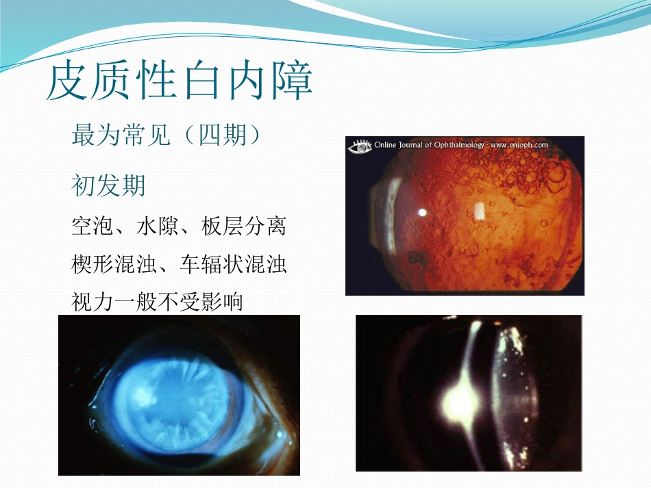 白内障的诊断与治疗_第4页