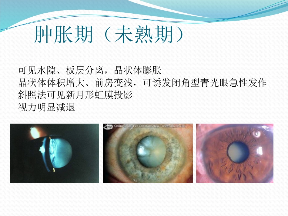 白内障的诊断与治疗_第5页