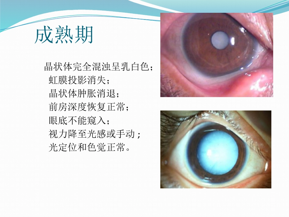 白内障的诊断与治疗_第6页