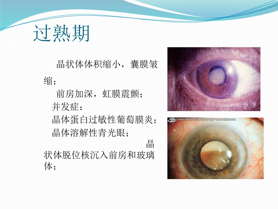 白内障的诊断与治疗_第7页