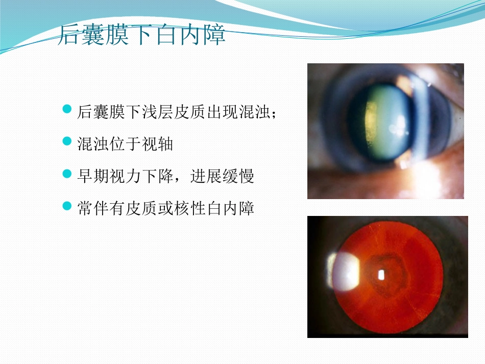 白内障的诊断与治疗_第9页