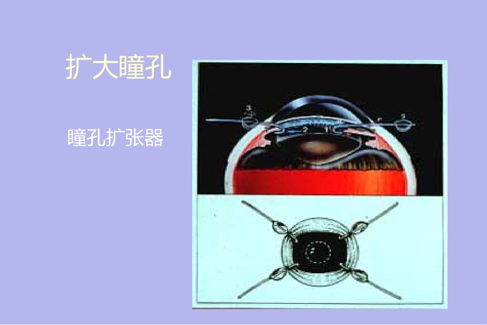 白内障并发症及其处理_第10页