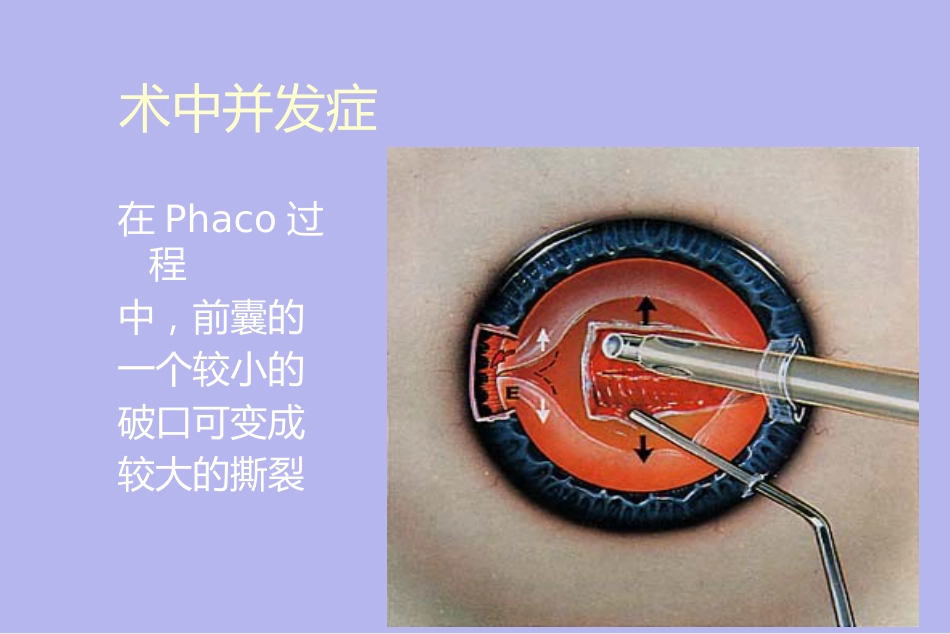 白内障并发症及其处理_第15页