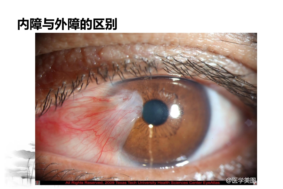 白内障疾病认识与治疗_第10页