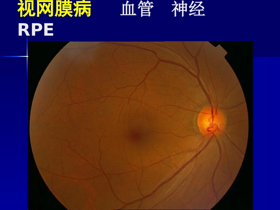 玻璃体 视网膜疾病_第4页