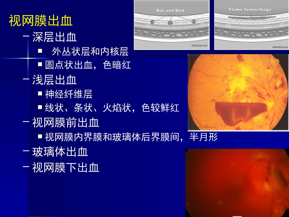 玻璃体 视网膜疾病_第7页