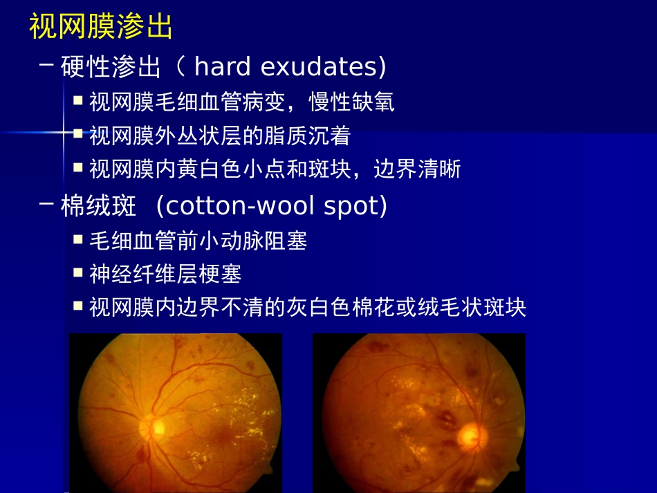 玻璃体 视网膜疾病_第8页