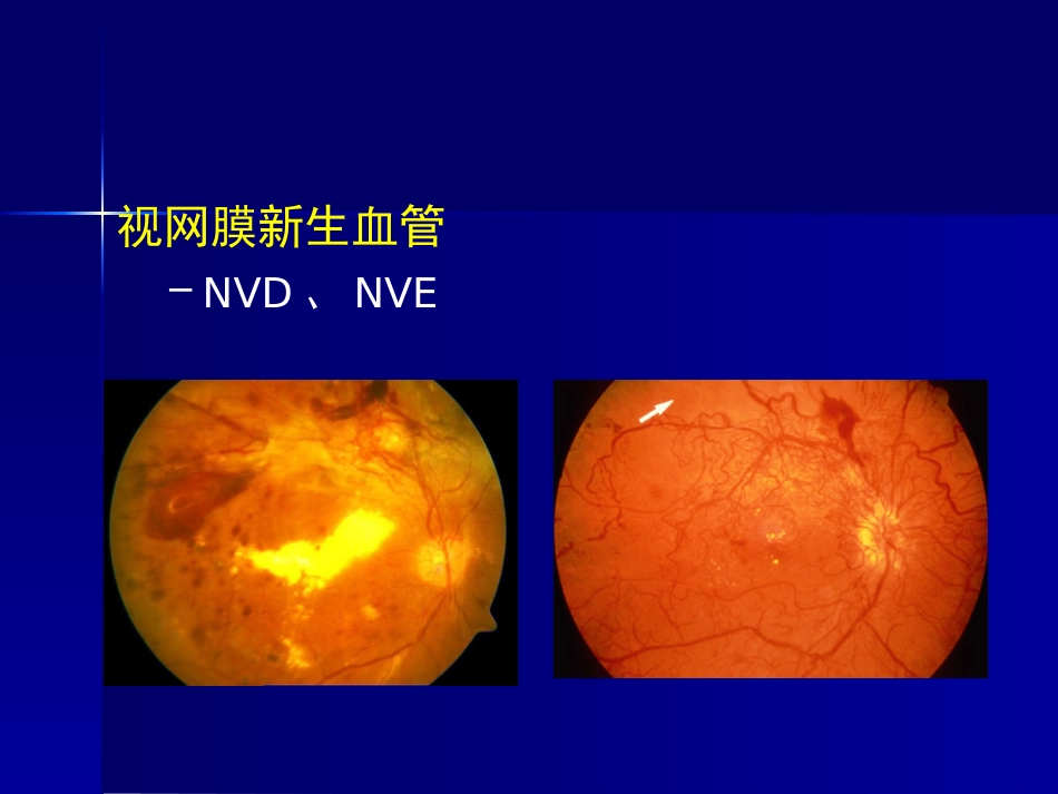 玻璃体 视网膜疾病_第9页