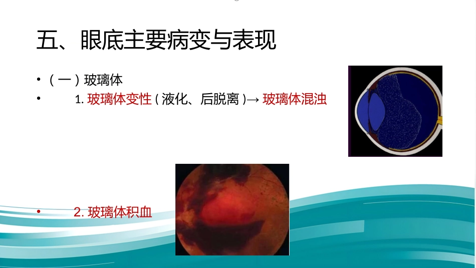 常见眼底病基础知识_第13页