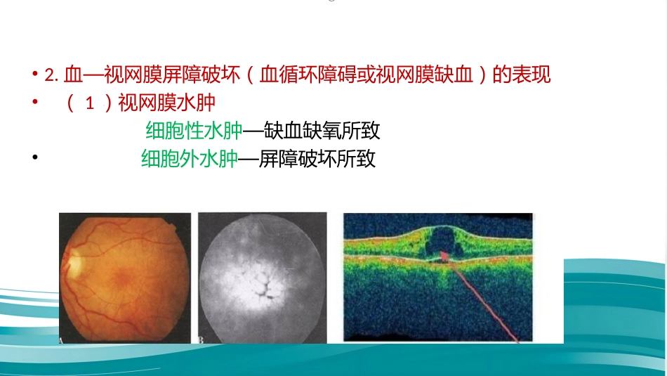 常见眼底病基础知识_第15页