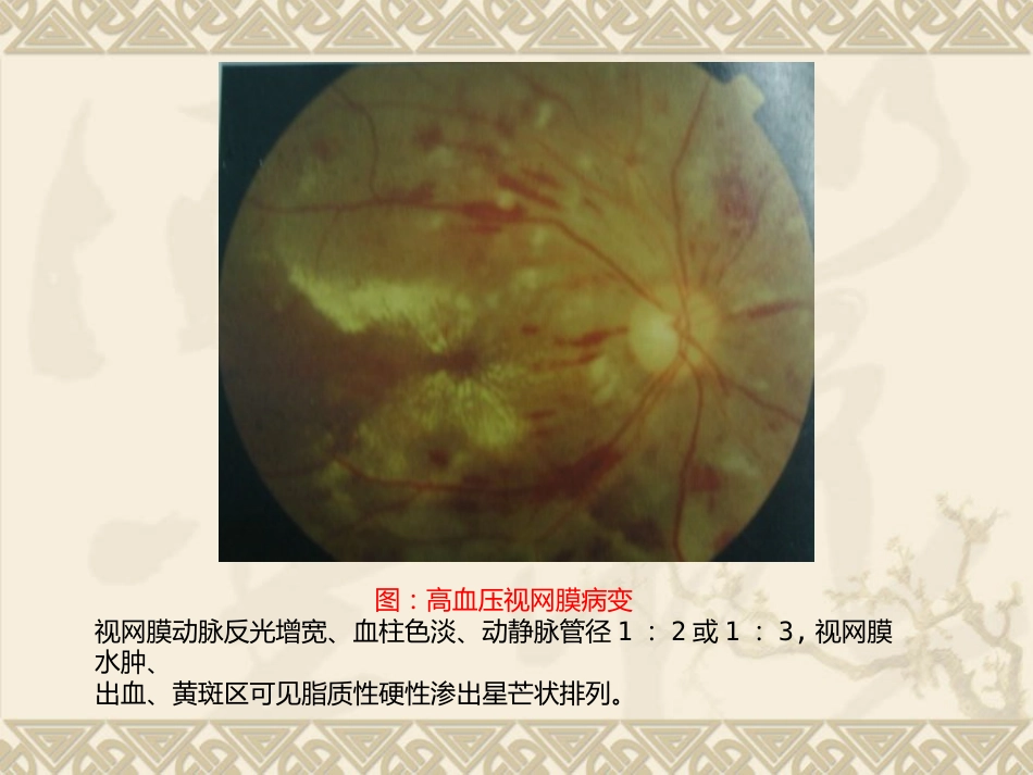 常见全身疾病的眼部表现_第8页