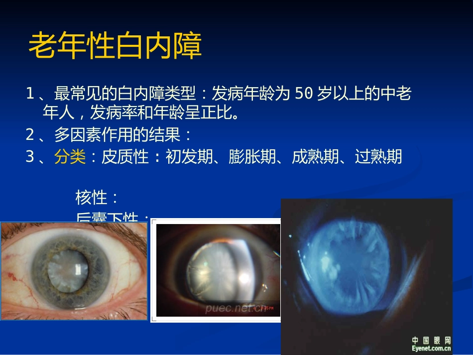 白内障_1_第12页