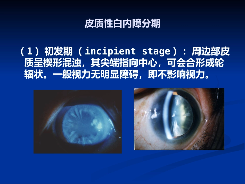 白内障_1_第13页