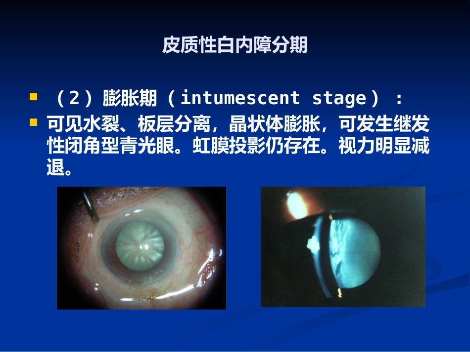 白内障_1_第14页