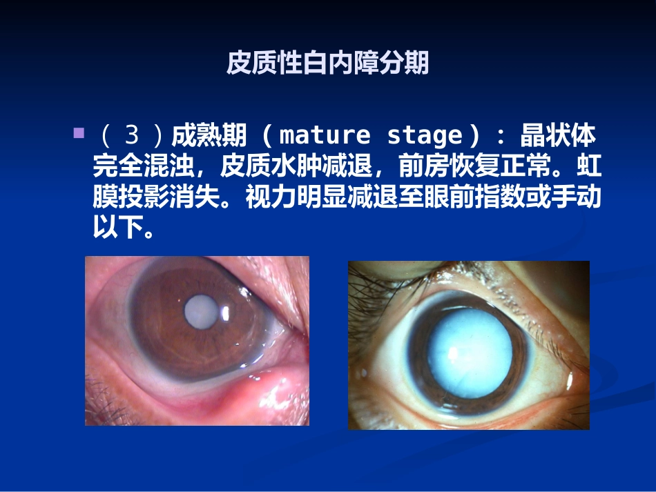 白内障_1_第15页
