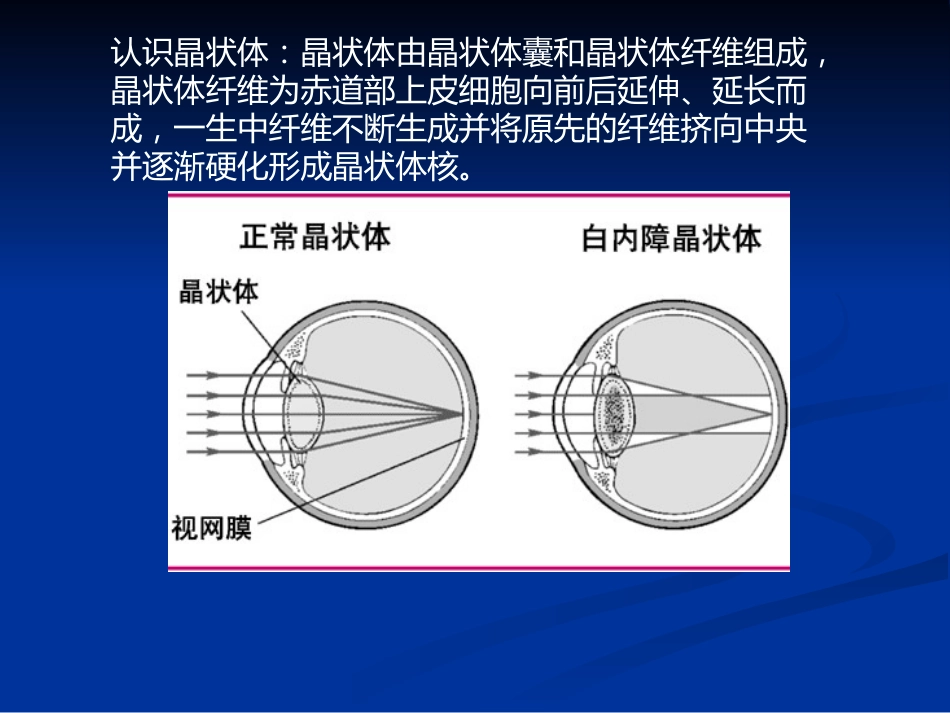 白内障_1_第4页
