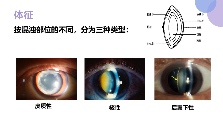 白内障的诊断与治疗(1)_第9页